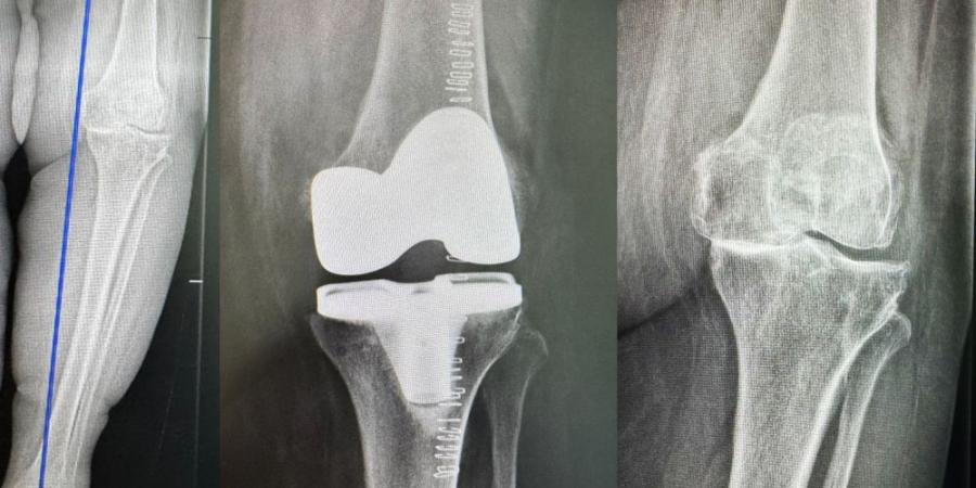 مستشفى الدكتور سليمان الحبيب بالخبر يُجري عملية دقيقة بالروبوت الجراحي لإعادة قدرة المشي لمراجعة “تسعينية” - وكالة Mea News